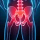 Understanding Hip Arthritis and Its Possible Impact on Daily Living