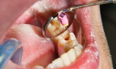Can a Tooth Heal Itself The Surprising Truth About Root Canal Treatment