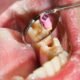 Can a Tooth Heal Itself The Surprising Truth About Root Canal Treatment
