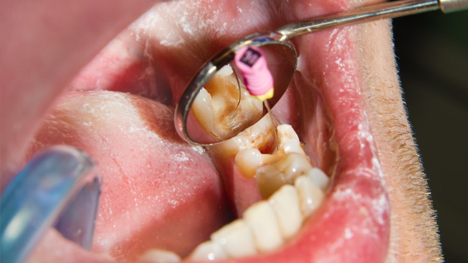Can a Tooth Heal Itself The Surprising Truth About Root Canal Treatment