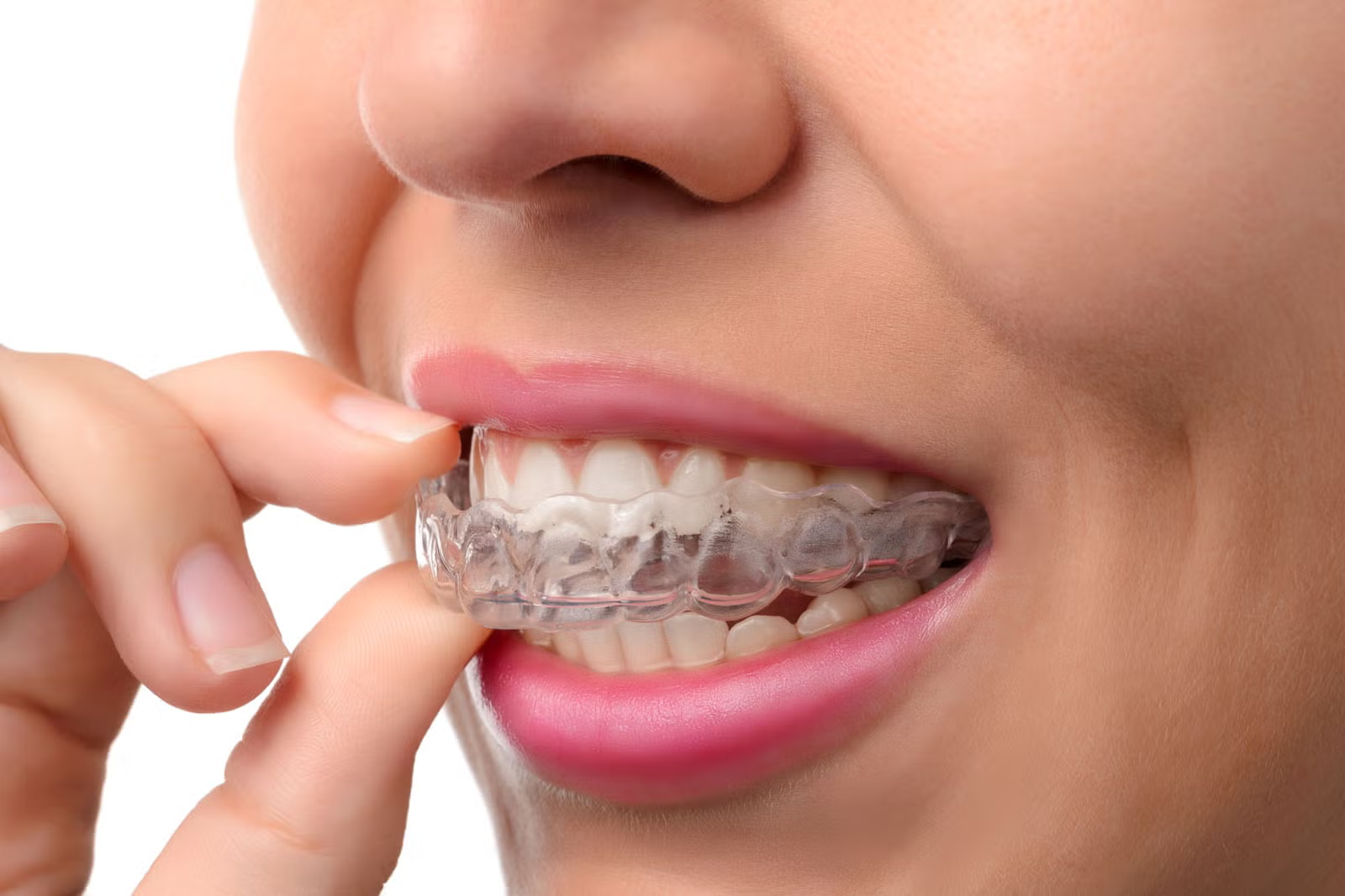 How to Straighten Teeth at Home with Aligners