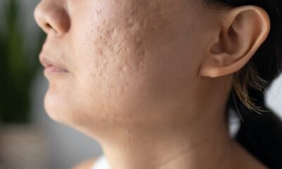 Laser vs. Microneedling for Acne Scar Removal in Singapore Cost and Results