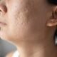 Laser vs. Microneedling for Acne Scar Removal in Singapore Cost and Results