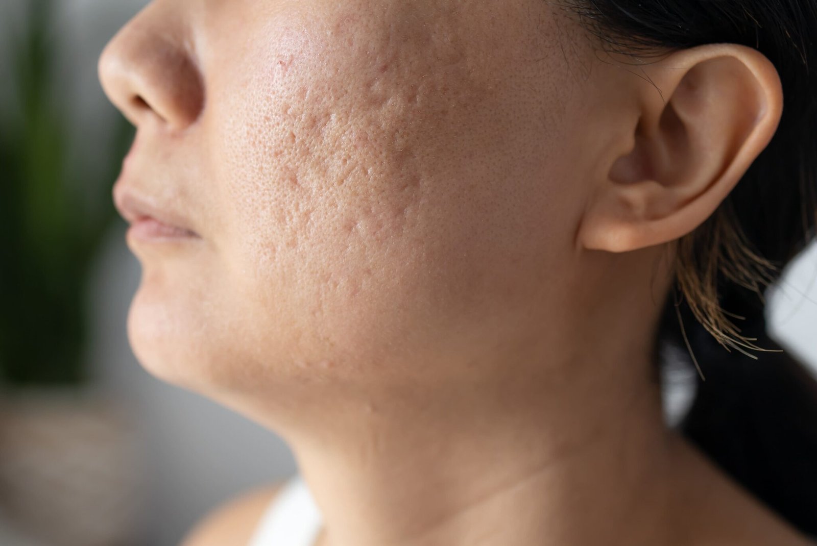 Laser vs. Microneedling for Acne Scar Removal in Singapore Cost and Results